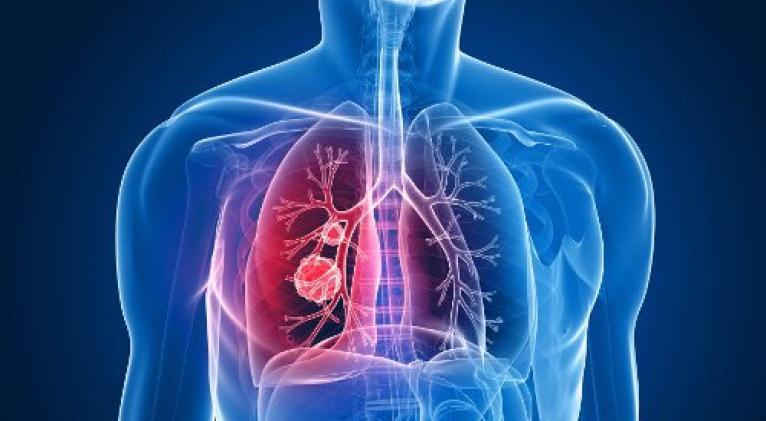 Cáncer de pulmón. Cáncer de pulmón.