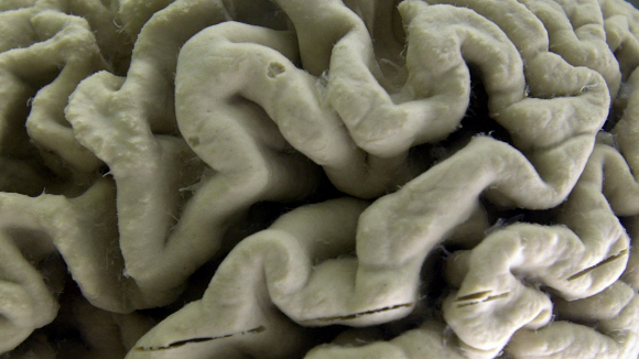virus causante de la covid-19 provoca la muerte de importantes células del sistema cerebrovascular Virus causante de la covid-19 provoca la muerte de importantes células del sistema cerebrovascular